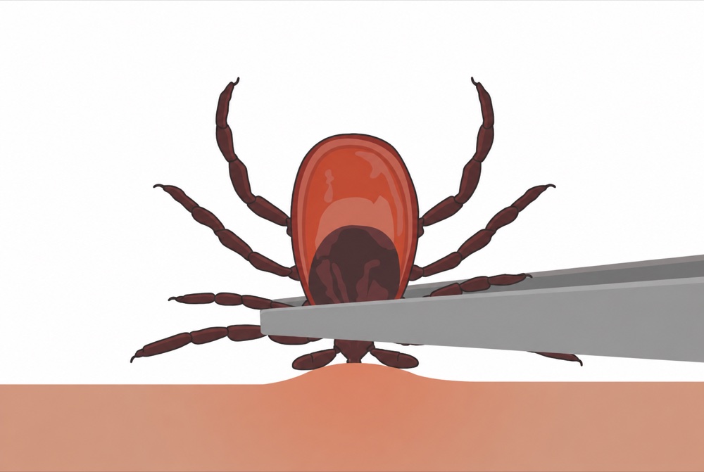Fine-tipped tweezers gripping a tick close to the skin